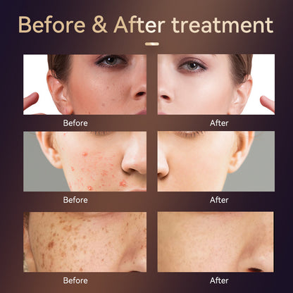 Dispositivo de rejuvenecimiento de fotones de 4 bandas para blanquear, iluminar, eliminar manchas, antienvejecimiento y belleza.